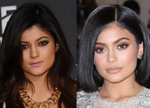 lip filler before and after 1