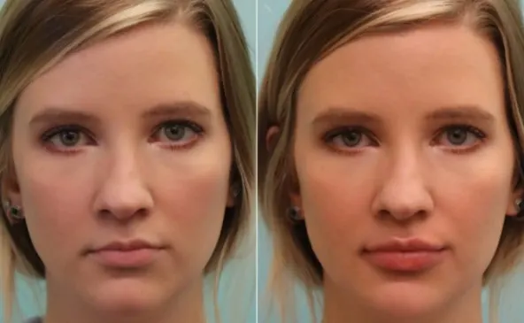 lip-filler-before-and-after