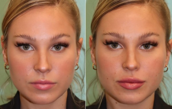 lip fillers before and after 2