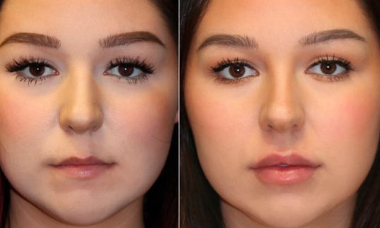 lip-fillers-before-and-after