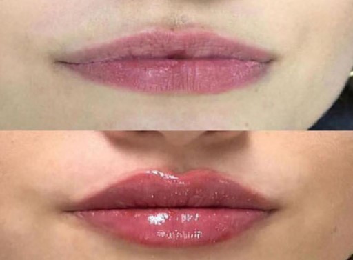 lip-swelling-2