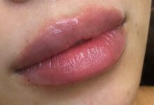 lip-swelling