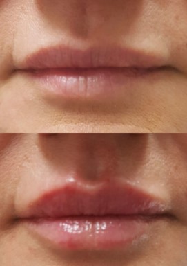 lip swelling after lip filler 1