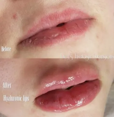 lip-swellings