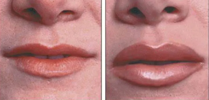 swollen-lip-2
