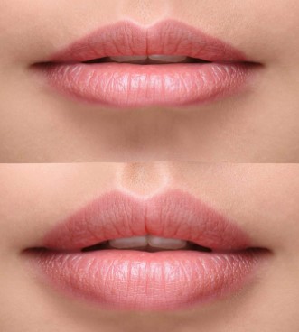 swollen-lips