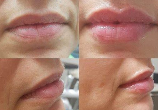 what-is-lip-augmentation