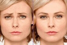 what to do after botox 1