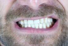 bruxism treatment with botox 1