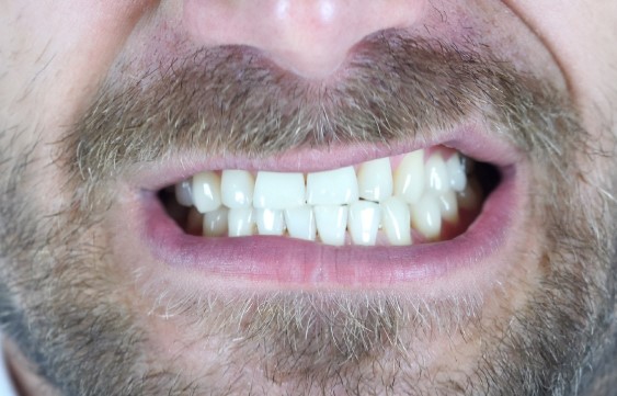 bruxism treatment with botox 1
