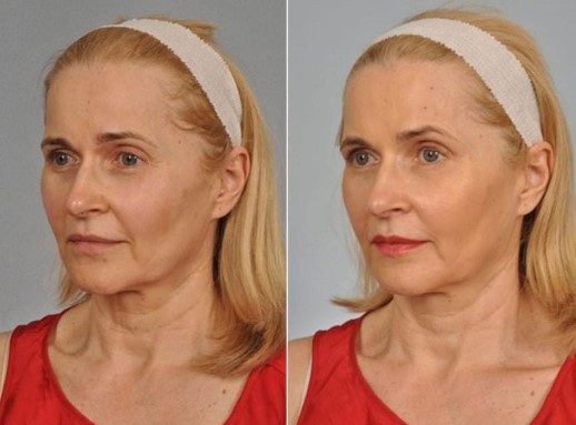 botox-for-aging-1