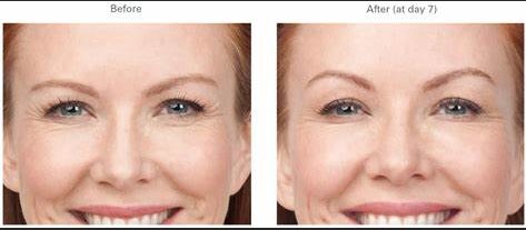 botox-for-crows-feet