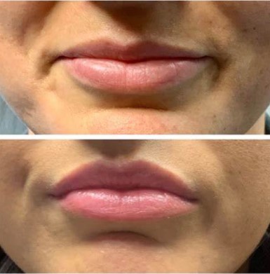 botox-for-lips