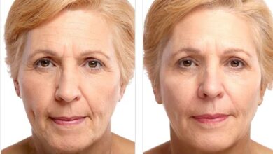 dermal-fillers-for-a-youthful-look-1
