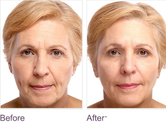 dermal-fillers-for-a-youthful-look-1