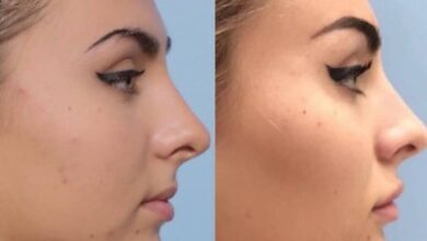 dermal fillers for chin 1
