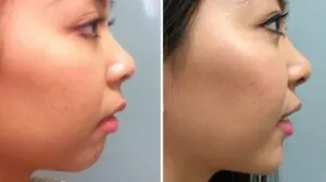 dermal-fillers-for-chin dermal-fillers-for-chin