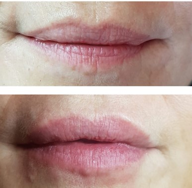 dermal-fillers-for-lips-1