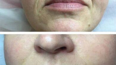 dermal fillers for youthful appearance 1