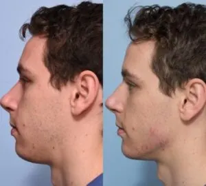 dermal-fillers-side-effects
