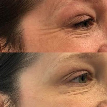 botox for crows feet 1 1