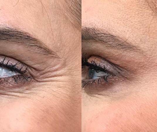 botox for crows feet
