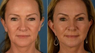 botox for face lift 1