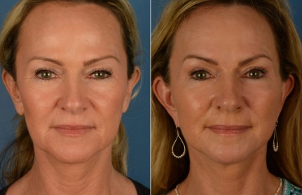 botox for face lift 1