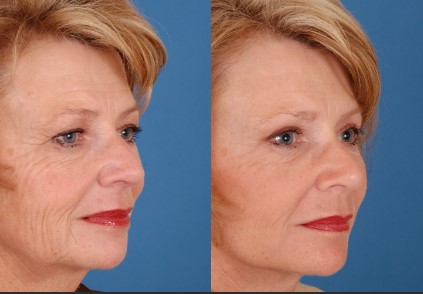 botox for face lift