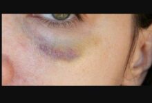 bruise after botox