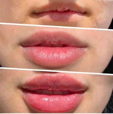 dermal fillers for lips 1 2