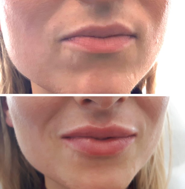 botox-for-lips-1