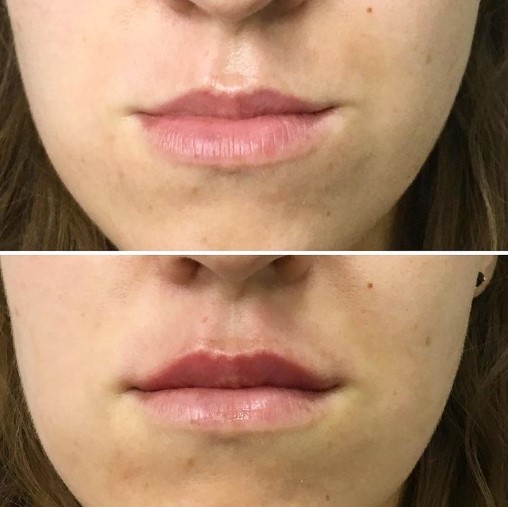 botox-for-lips-2