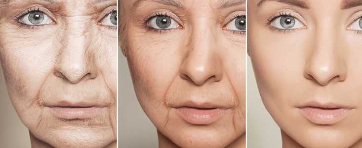 the-anti-aging-benefits-of-botox