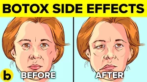 what are Botoxs side effects
