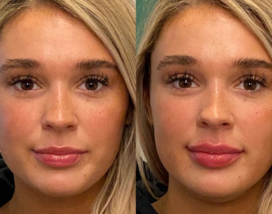 bad-lip-injections-1-1