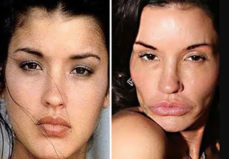 bad-lip-injections-1