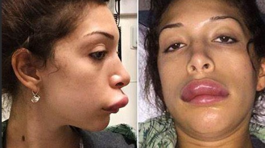 bad-lip-injections