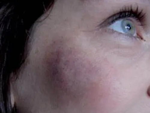botox bruising 1