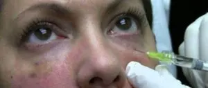 What does bruising after botox mean?