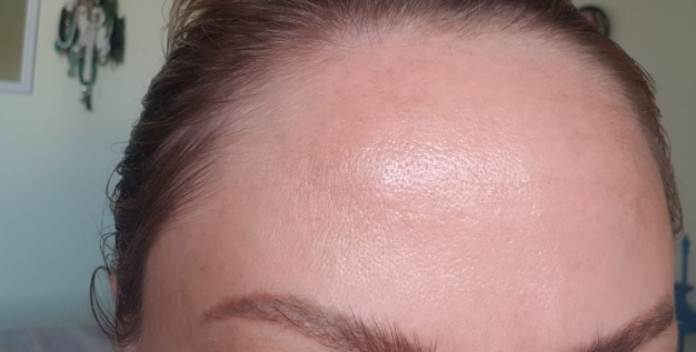 botox-bruising-forehead-4