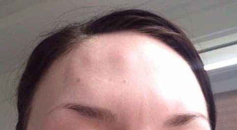 botox-bruising-forehead-5