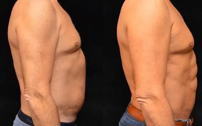 botox-for-abs-1