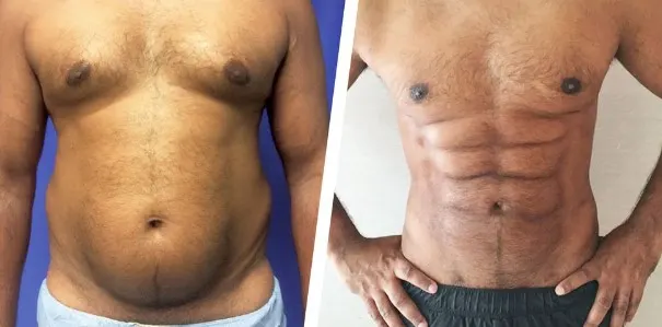 botox-for-abs-2