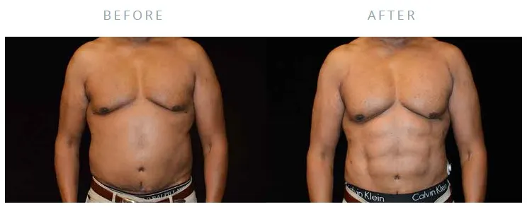 botox for abs