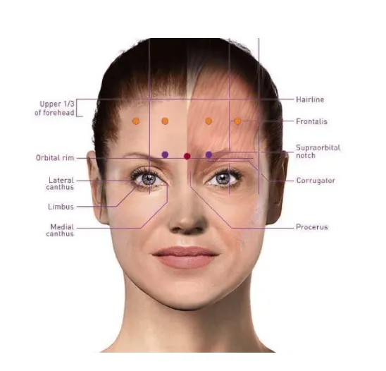 botox-for-migraine-1 botox-for-migraine-1