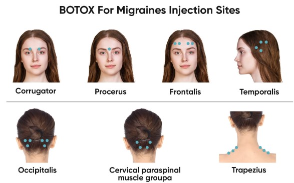 botox-for-migraine
