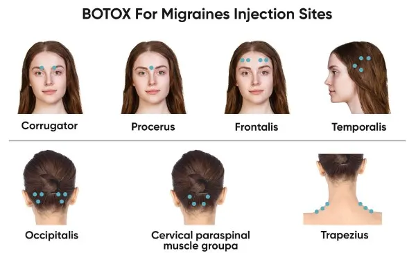 botox-for-migraine botox-for-migraine