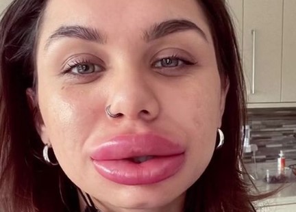 botox-swelling-on-lips