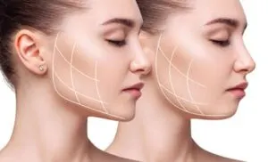 botox-swelling-on-the-jawline